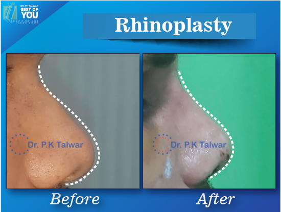 rhinoplasty surgery result